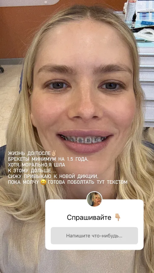 Елена Перминова призналась, что долго решалась поставить брекеты
