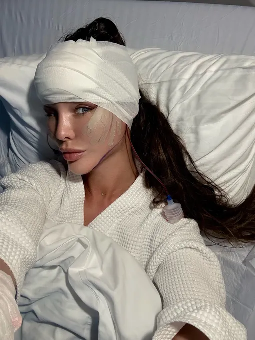 Светлана Сильваши после пластики лица