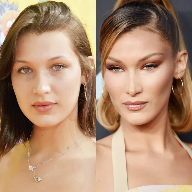 От удаления комков Биша до броулифтинга: пластика, которая может тебя состарить