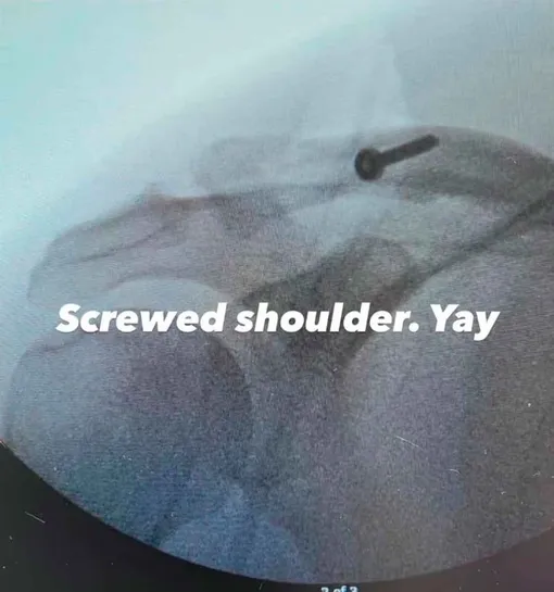 Врачи вставили актеру шуруп в ключицу для стабилизации сустава