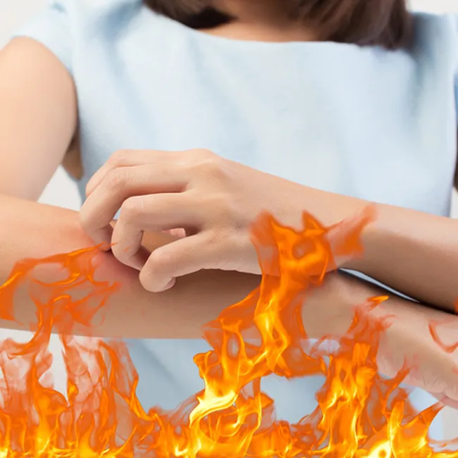 Когда у тебя «АД»: честно и без купюр об атопическом дерматите