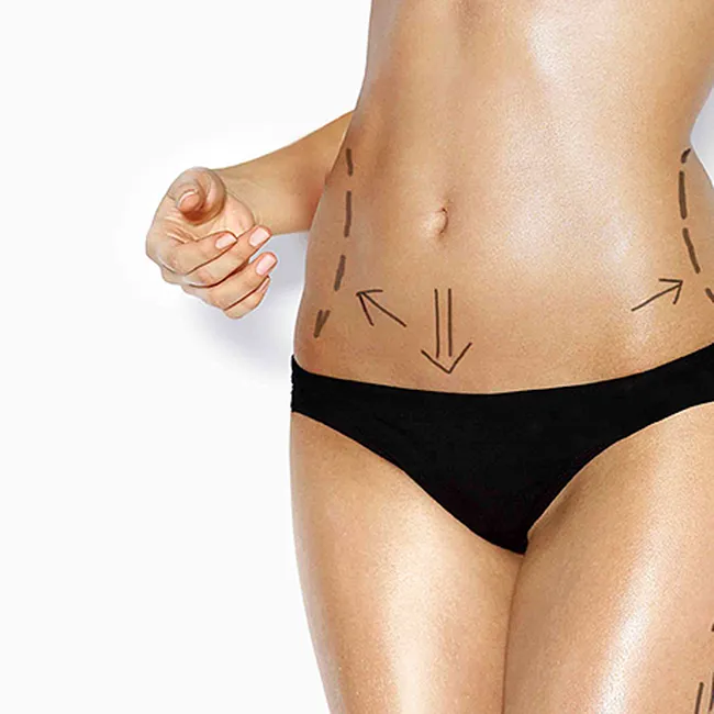 Жировые «ловушки»: что делать, если похудеть не помогают ни фитнес, ни диета?