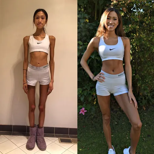 Девушка похудела до 30 кг