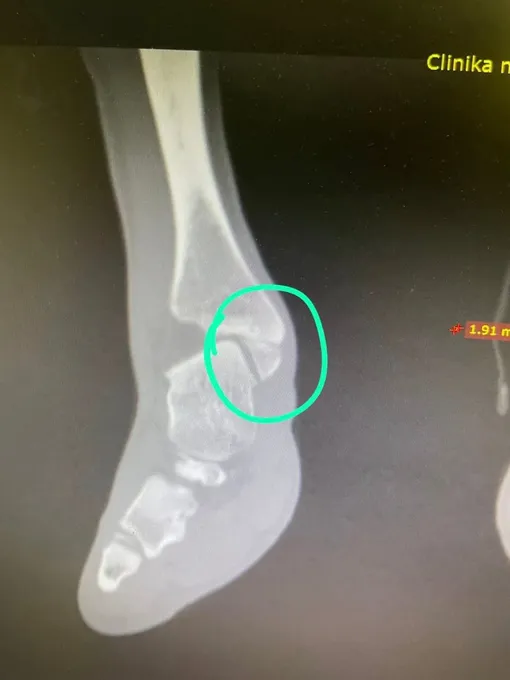 Торнике Квитатиани сломал ногу