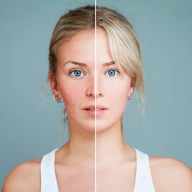 Война с акне: как выбрать эффективное средство от прыщей на лице