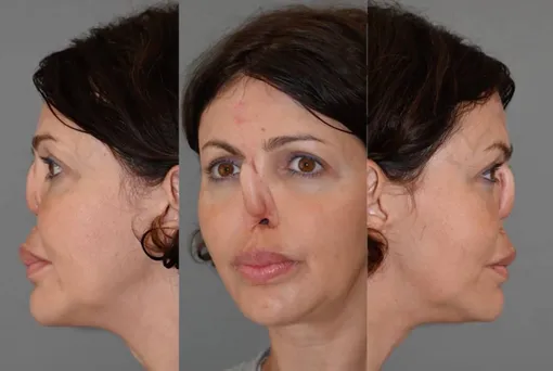 Алиса Аршавина призналась, что после операции ее нос превратился в «лепесток»