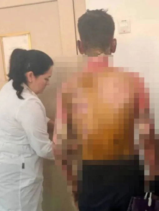 У одного из пострадавших мальчиков 50% ожогов всего тела