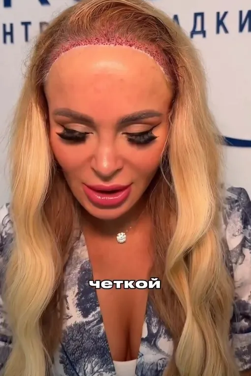 Анна Калашникова после процедуры Анна Калашникова после процедуры
