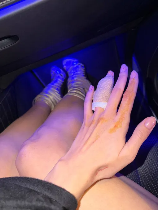 Вале Карнавал зашили рану на пальце Вале Карнавал зашили рану на пальце