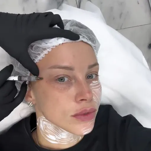 Полина Диброва сделала биоривитализацию