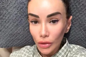 «Я совершила главную ошибку»: Айза показала лицо без повязок после пластики в Корее