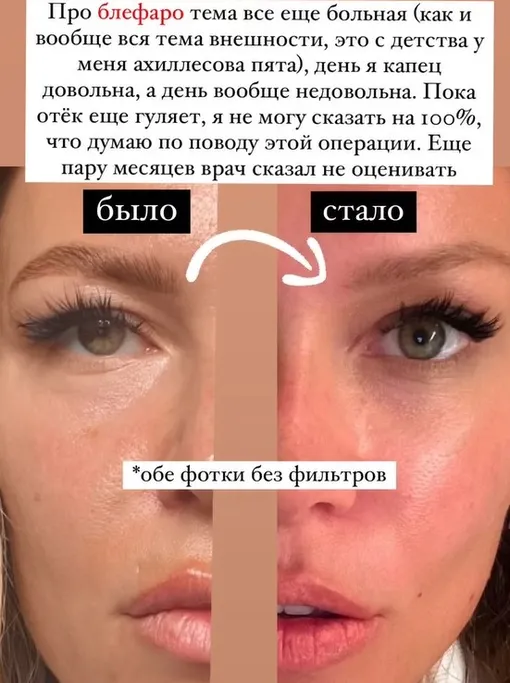 Рита Дакота до и после пластики Рита Дакота до и после пластики